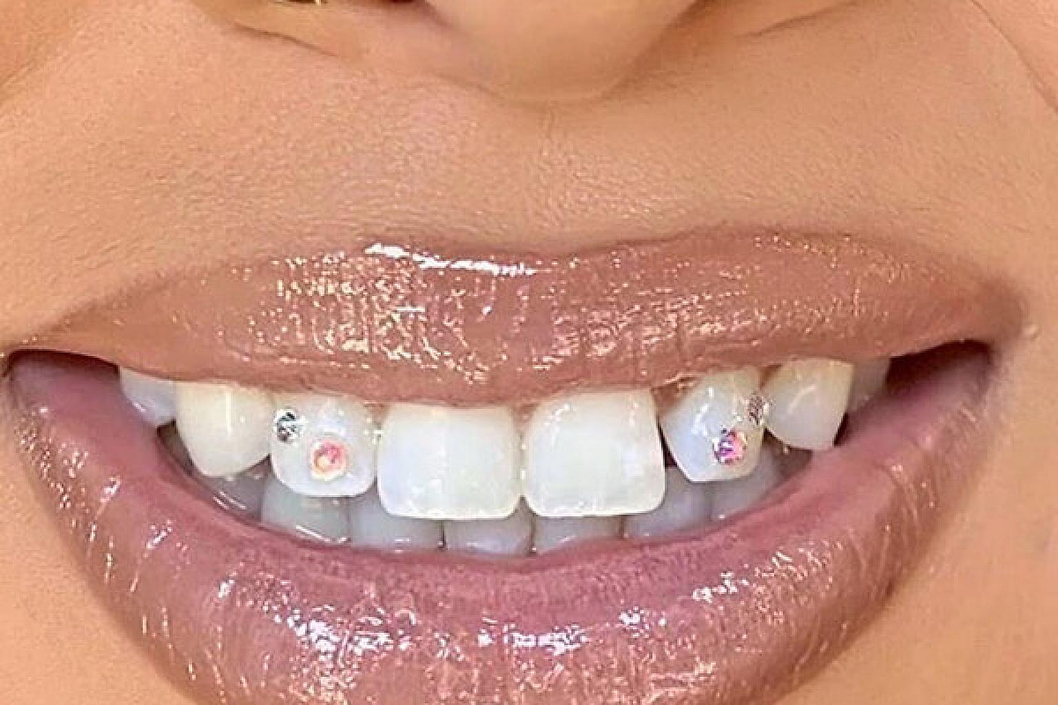 Украшение зубов бриллиантами