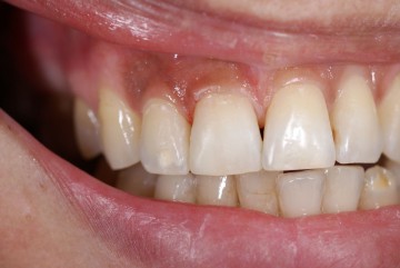 Лечение зубов клиника Улыбка Самара