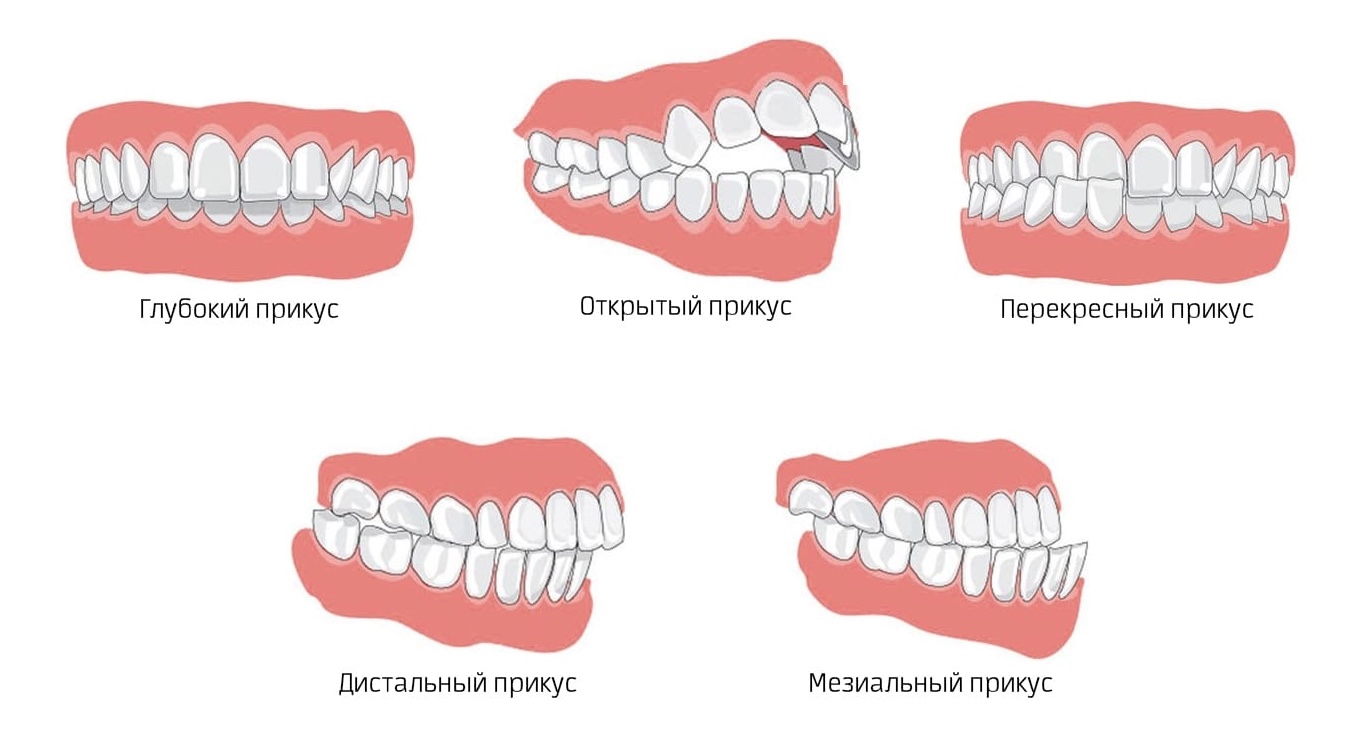 Неправильный прикус