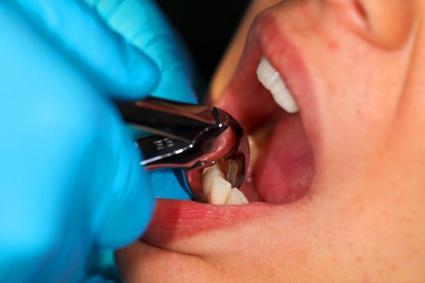 Удаление зубов клиника Улыбка Самара